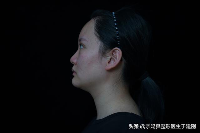 一张图看懂鼻基底凹陷对比图，塌鼻秒变立体质感鼻