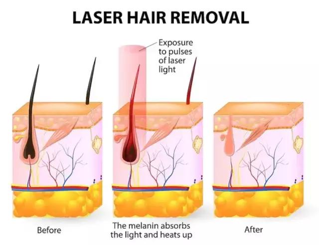 怎么永久脱腿毛，怎样永久脱腿毛（最最最最有效的居然是这一种）