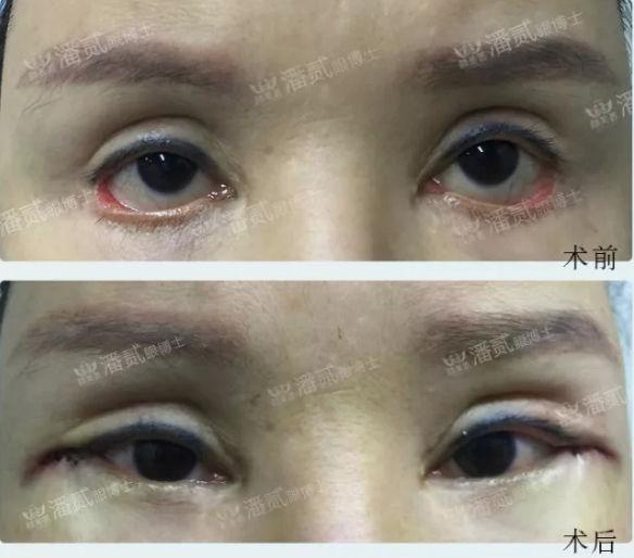 三白眼是什么意思，下三白眼的女人（下睑下至注意分寸）