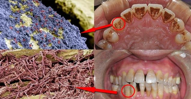 牙结石症状,日积月累形成脏石头(有牙结石该怎么办)
