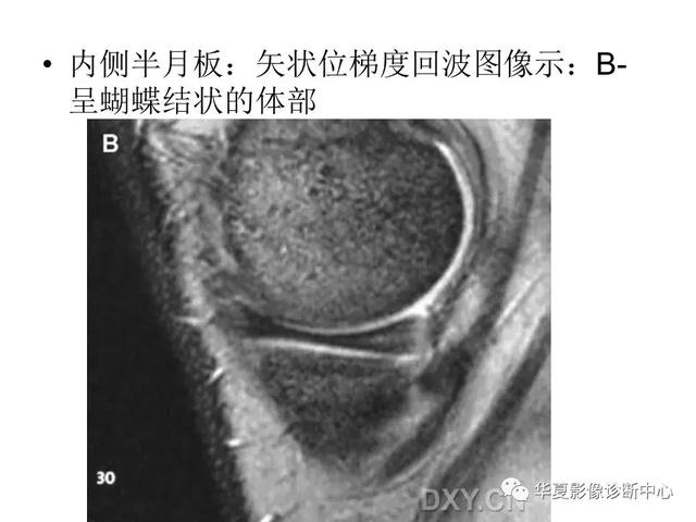 膝关节解剖结构图，膝盖解剖图示意图（膝关节MRI之正常解剖综述）