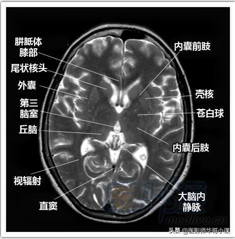 颅脑mri(头部MRI)插图(9)