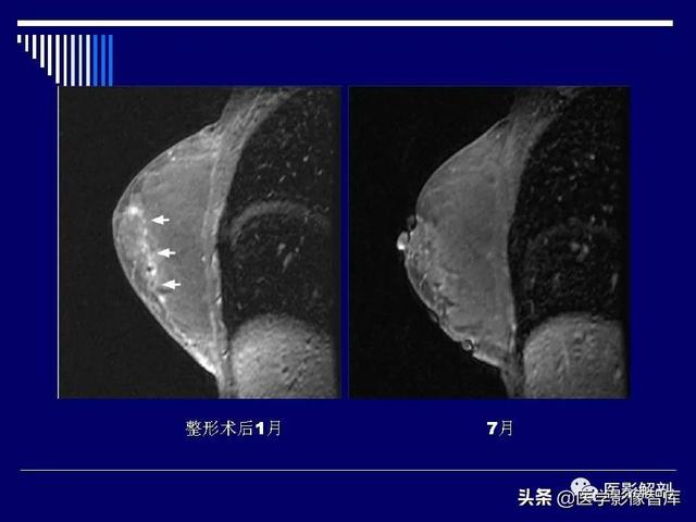 乳房解剖学基础知识，乳腺解剖及乳腺各病变影像诊断与鉴别