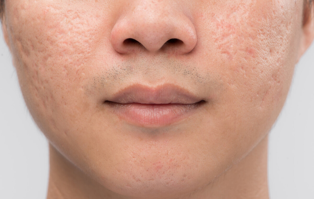 痘坑一辈子都不会好吗，激光祛痘印痘坑多少钱一次（能否选择‘’无恢复期‘’的治疗项目）