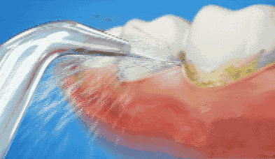 超声波洁牙多少钱,超声波洁牙和舒适洁牙有什么区别(抢价值268元单人