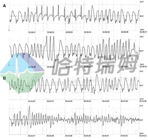室颤的典型心电图表现，警惕室颤突然来袭