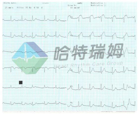 室颤的典型心电图表现，警惕室颤突然来袭