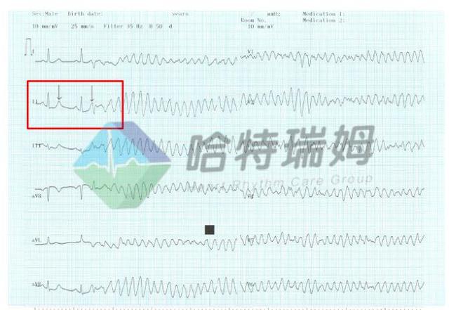室颤的典型心电图表现，警惕室颤突然来袭