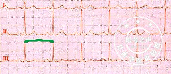 通俗易懂的心电图基础介绍，零基础都秒懂：学习心电图