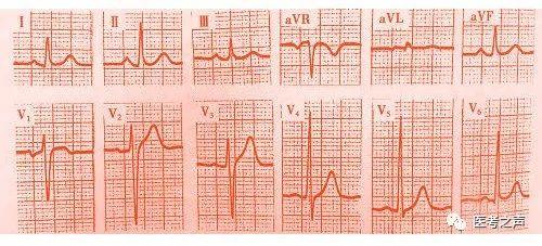通俗易懂的心电图基础介绍，零基础都秒懂：学习心电图