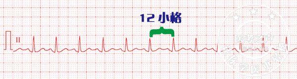 通俗易懂的心电图基础介绍，零基础都秒懂：学习心电图