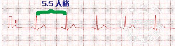 通俗易懂的心电图基础介绍，零基础都秒懂：学习心电图