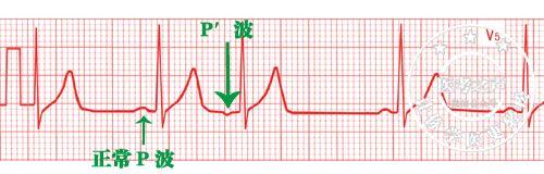 通俗易懂的心电图基础介绍，零基础都秒懂：学习心电图
