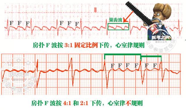 通俗易懂的心电图基础介绍，零基础都秒懂：学习心电图