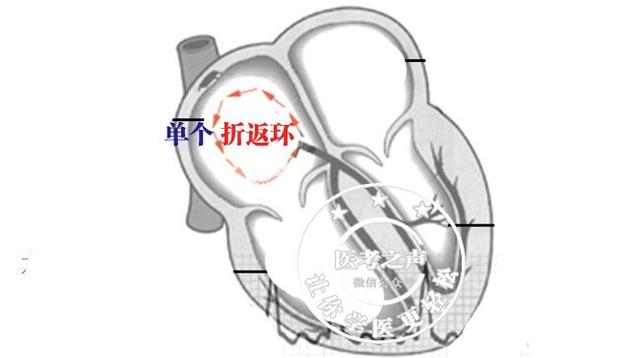 通俗易懂的心电图基础介绍，零基础都秒懂：学习心电图