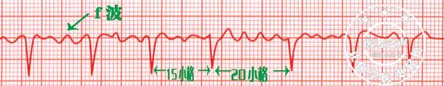 通俗易懂的心电图基础介绍，零基础都秒懂：学习心电图