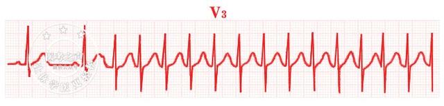 通俗易懂的心电图基础介绍，零基础都秒懂：学习心电图
