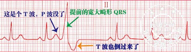 通俗易懂的心电图基础介绍，零基础都秒懂：学习心电图