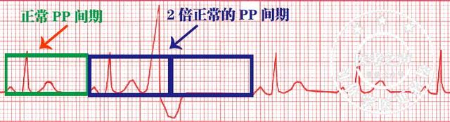 通俗易懂的心电图基础介绍，零基础都秒懂：学习心电图