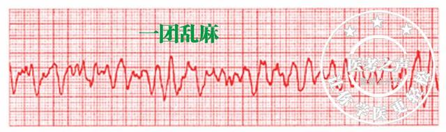 通俗易懂的心电图基础介绍，零基础都秒懂：学习心电图