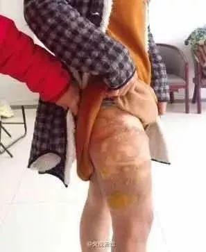 如何挑选热水袋，热水袋的气怎么排出（如何正确挑选电热水袋）