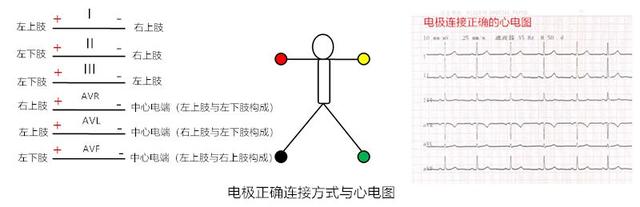 心电图所有导联的放置位置，肢体导联电极错接的心电图分析及鉴别