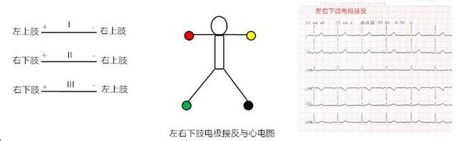 心电图所有导联的放置位置，肢体导联电极错接的心电图分析及鉴别