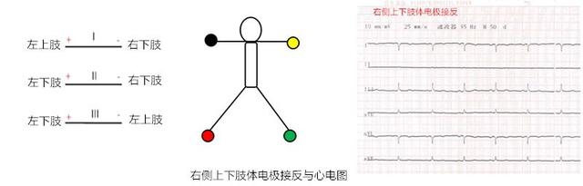 心电图所有导联的放置位置，肢体导联电极错接的心电图分析及鉴别