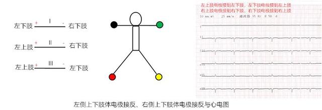 心电图所有导联的放置位置，肢体导联电极错接的心电图分析及鉴别