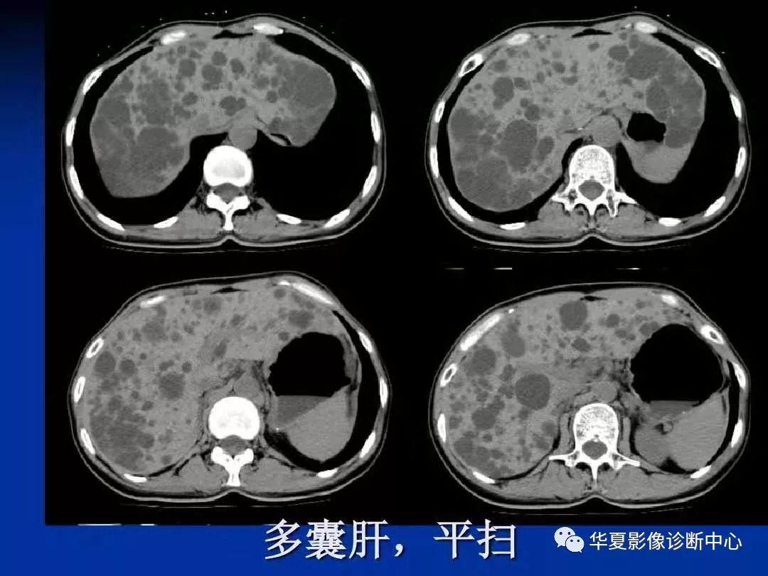 多囊肝多囊肾怎么治疗(多囊肾多囊肝是什么病严重吗)