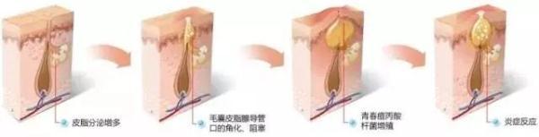 长痘痘吃什么药，脸上长痘痘（为什么你总是反复长痘）