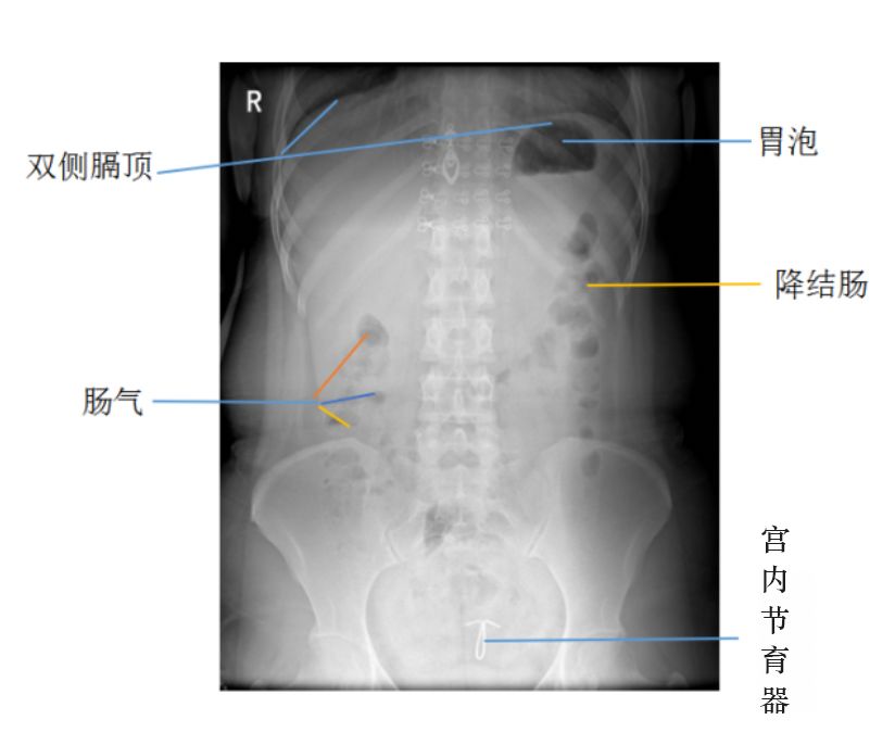 消化道穿孔影像学表现,原来要这样看!