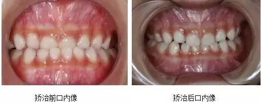 地包天牙一定要矫正吗，地包天牙齿矫正的最佳年龄和价格（否则不仅影响咀嚼）