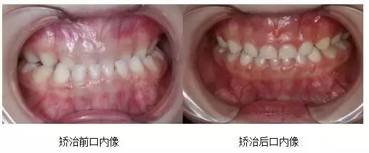 地包天牙一定要矫正吗，地包天牙齿矫正的最佳年龄和价格（否则不仅影响咀嚼）