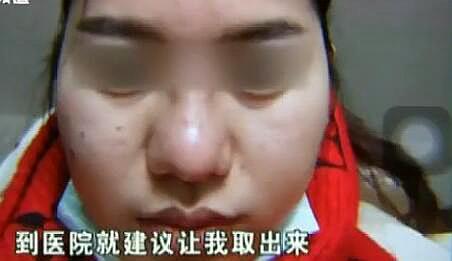 隆鼻子多少钱，隆鼻价格要多少钱（女子花2万元做隆鼻手术）