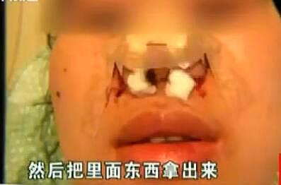 隆鼻子多少钱，隆鼻价格要多少钱（女子花2万元做隆鼻手术）