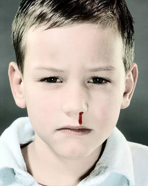 小孩流鼻血怎么办，八岁小孩流鼻血怎么办（医生给出处理方案了）