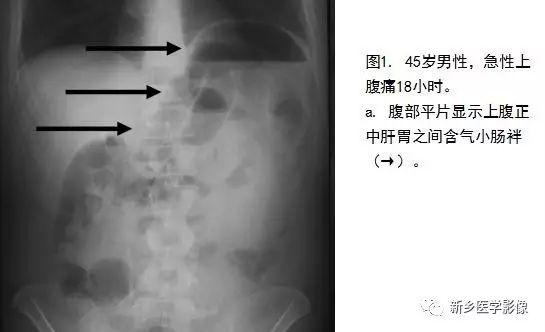 疝气是哪个部位，疝气是在什么部位（没有一种是容易诊断的）