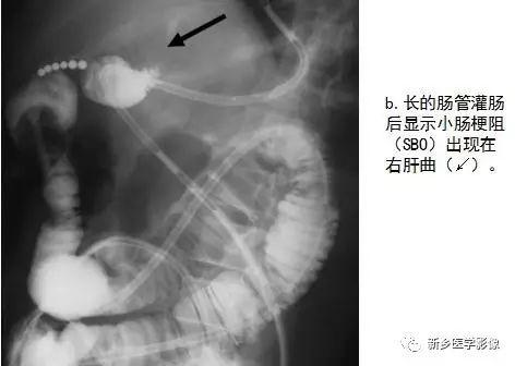 疝气是哪个部位，疝气是在什么部位（没有一种是容易诊断的）