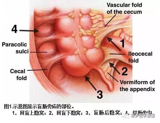 疝气是哪个部位，疝气是在什么部位（没有一种是容易诊断的）