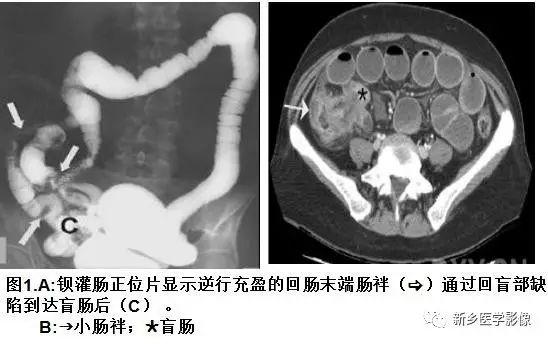 疝气是哪个部位，疝气是在什么部位（没有一种是容易诊断的）