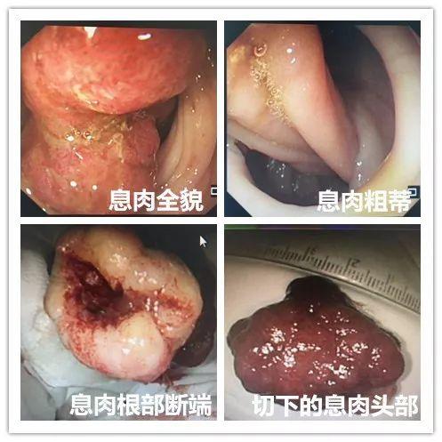 什么肠小道，什么肠小道(含动物)（附属三院消化二科成功切除肠道巨大息肉）