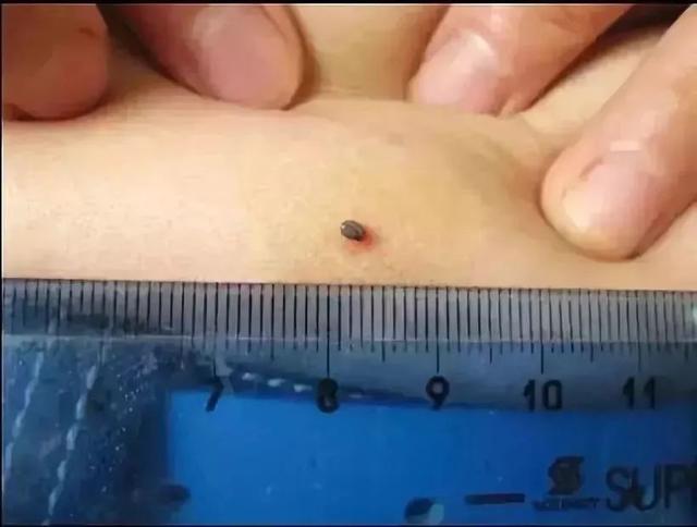 身上长黑点是怎么回事，身上长黑色斑点是什么原因（身上冒出这种“小黑点”别乱拔）