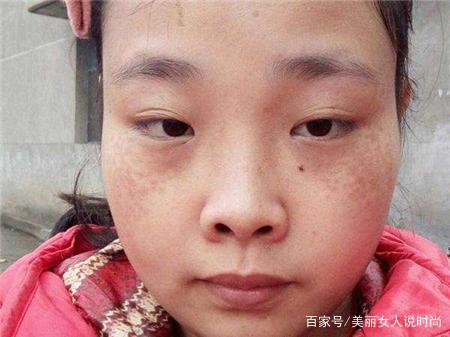 柠檬怎样使用能够祛斑，女人脸上长色斑