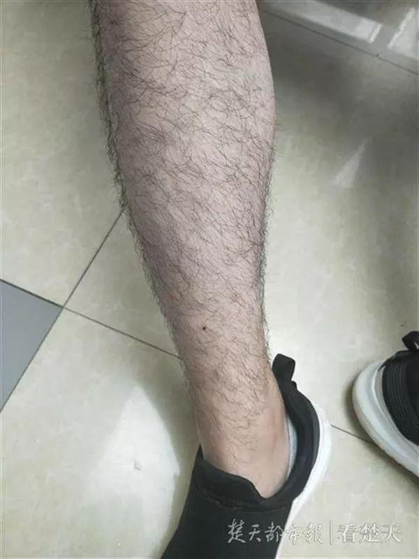 身上长黑点是怎么回事，身上长黑色斑点是什么原因（身上冒出这种“小黑点”别乱拔）