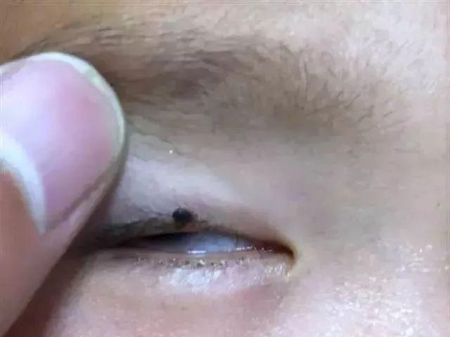 身上长黑点是怎么回事，身上长黑色斑点是什么原因（身上冒出这种“小黑点”别乱拔）
