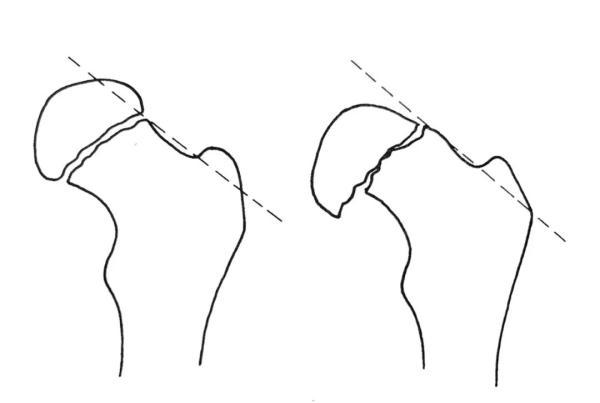 如何踢出s型弧线球，怎样踢出s型球（大诊治误区盘点）