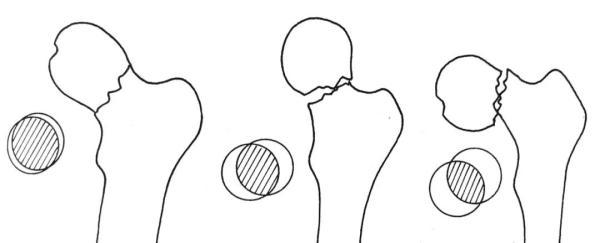 如何踢出s型弧线球，怎样踢出s型球（大诊治误区盘点）