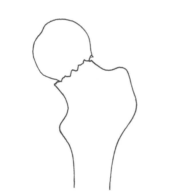 如何踢出s型弧线球，怎样踢出s型球（大诊治误区盘点）