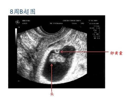 b超单各种数据怎么看，胎宝宝不再有“秘密”